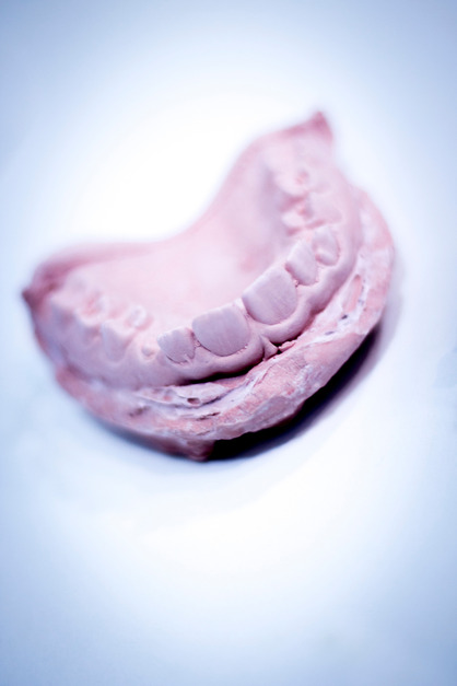 prótesis dental 4